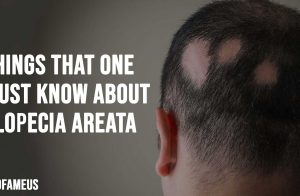 Things That One Must Know About Alopecia Areata