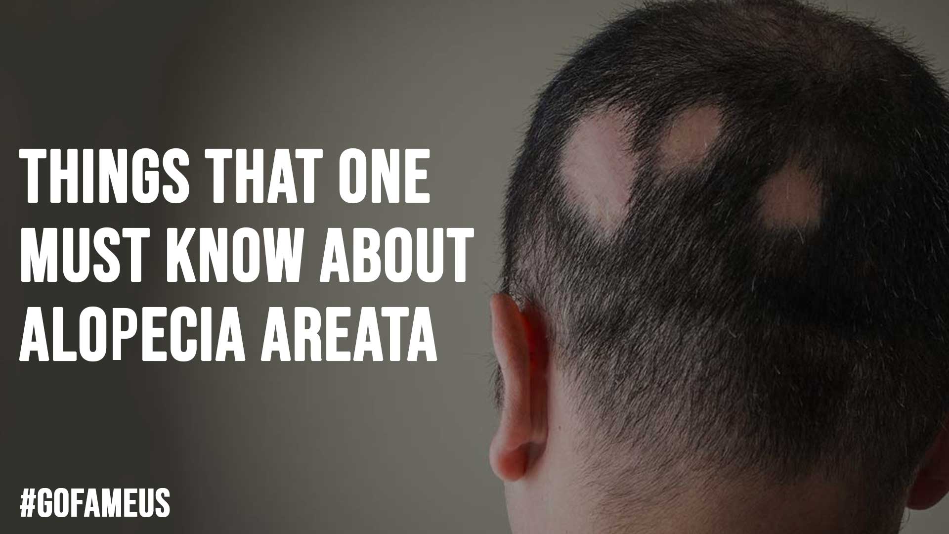 Things That One Must Know About Alopecia Areata