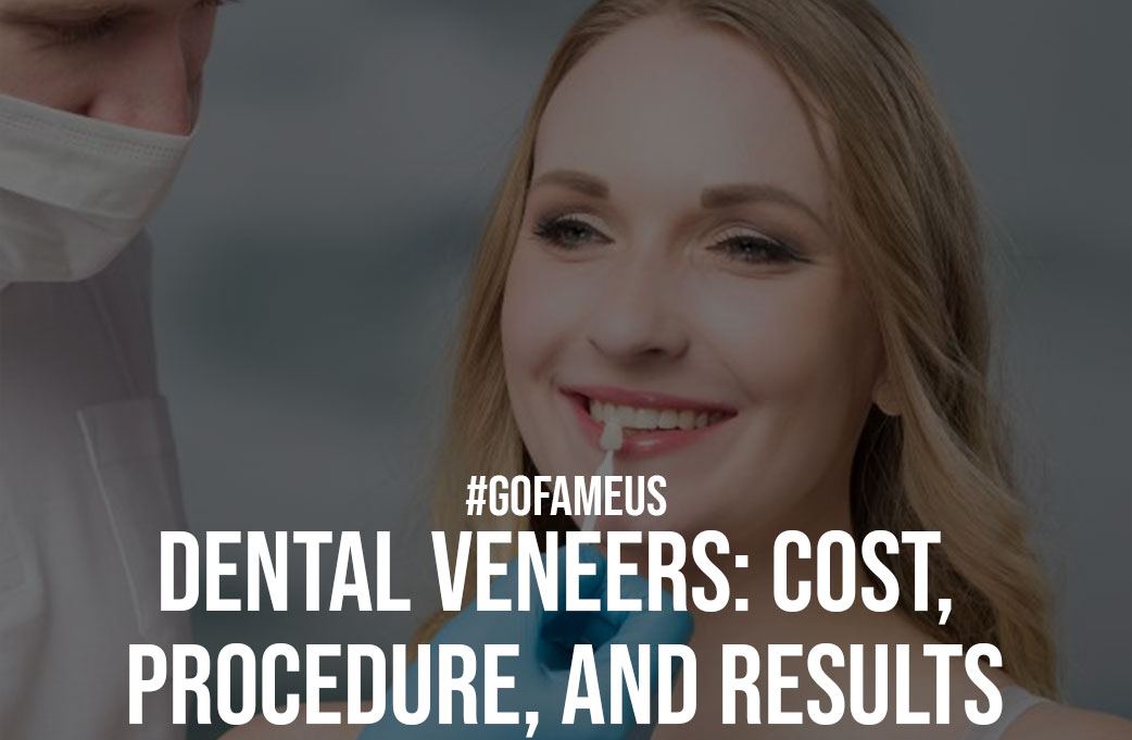 Dental Veneers Cost Procedure and Results